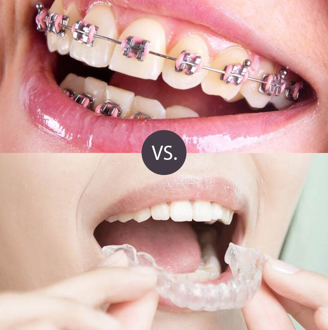 How Long Do You Have To Wear Invisalign After Braces