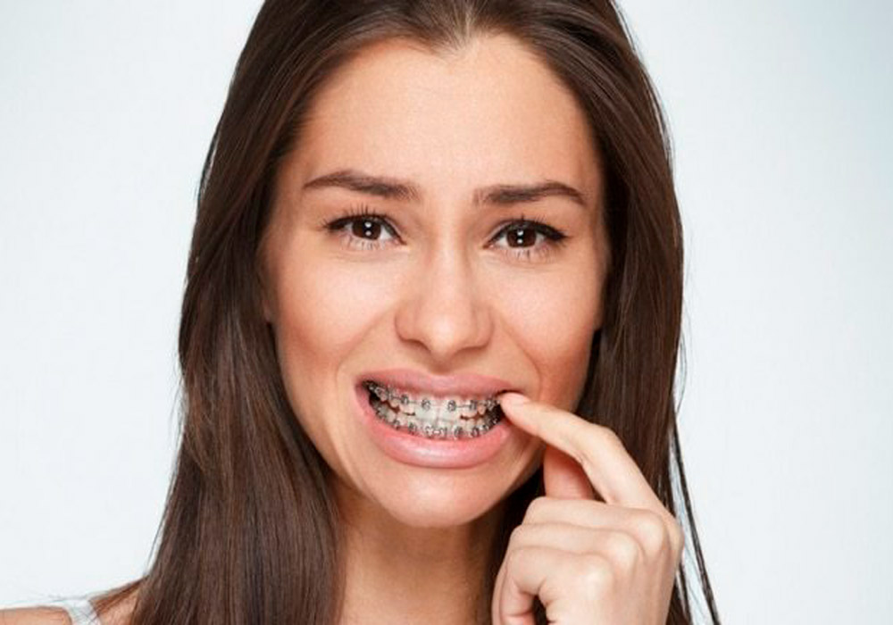 Image of woman in pain because of the braces on her teeth - Omar Orthodonti...