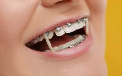 Can Adult Orthodontics Fix Bite Problems Without Surgery?