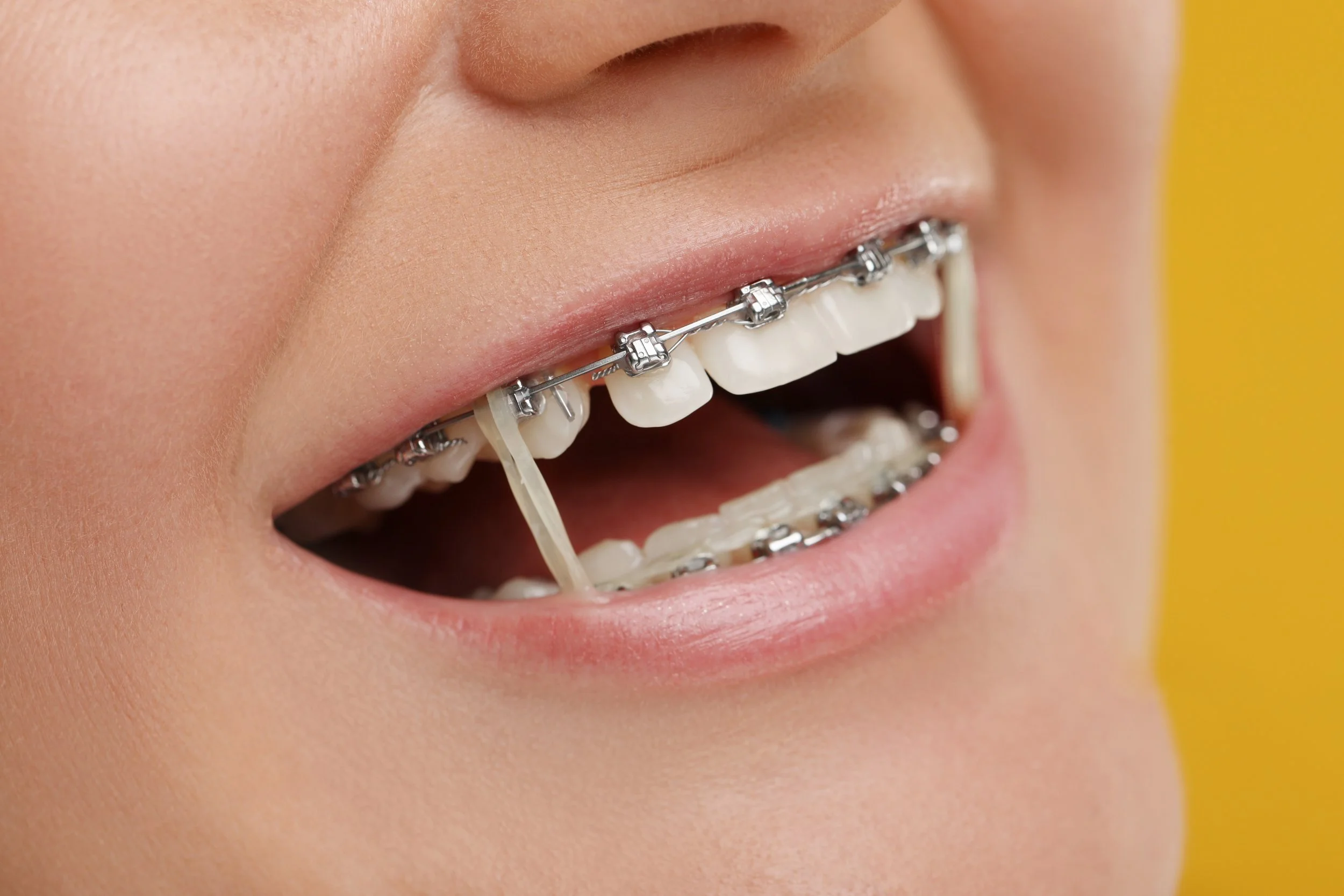 Adult Wearing Braces With Orthodontic Elastics Close-up of an adult wearing traditional braces with orthodontic rubber bands to help correct bite alignment.