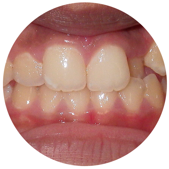 Tooth Crowding - Before Omar Orthodontics