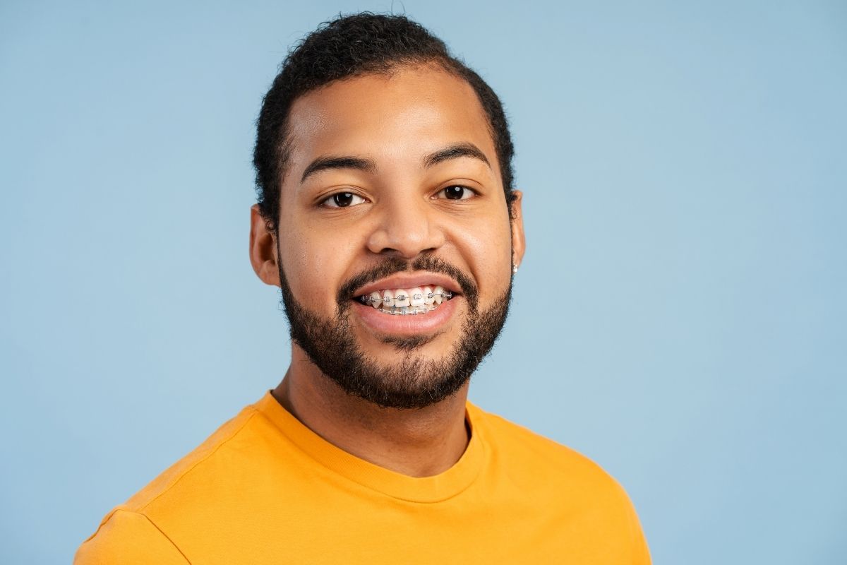 Adult Smiling With Metal Braces Adult smiling while wearing traditional metal braces on the upper teeth.