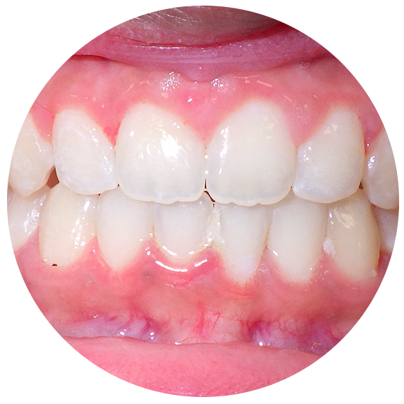 Overbite fixed - After Omar Orthodontics