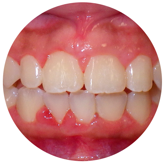 Properly Aligned Teeth - After Omar Orthodontics
