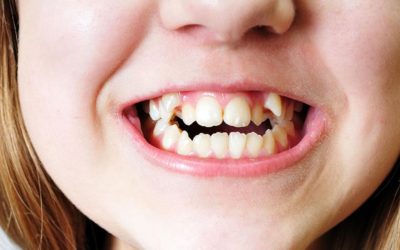 Correct All Types of Malocclusions with Orthodontic Treatments