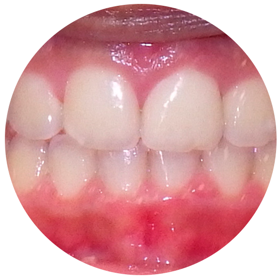 Resolved Tooth Crowding - After Omar Orthodontics