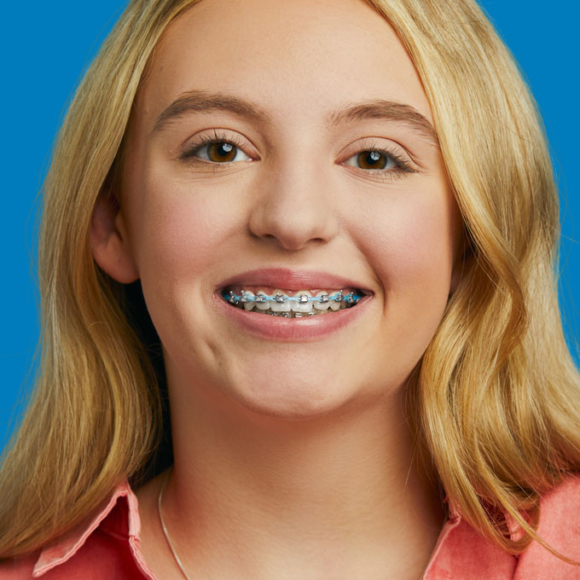 Smiling Patient Wearing Traditional Metal Braces Smiling person wearing traditional metal braces on the upper teeth.